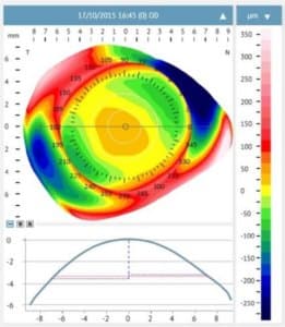 3D corneal and scleral height map produced by the Eaglet-Eye Surface Profiler