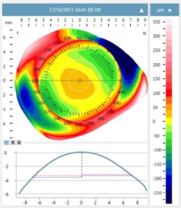 3D corneal and scleral height map produced by the Eaglet-Eye Surface Profiler